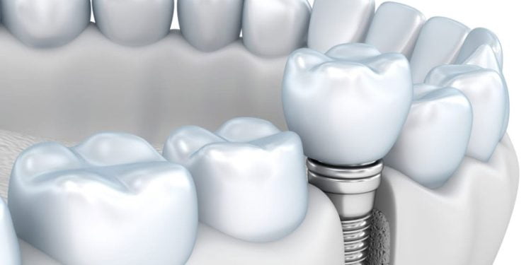 Everything you need to know about the zygomatic implant and its related advantages