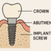 Know About Dental Implants
